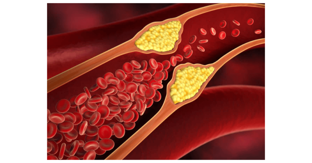 high cholesterol